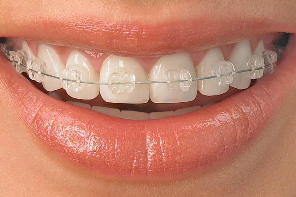 Ceramic (Clear) Braces