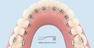 Lingual Braces